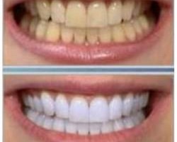 Aprender a blanquear tus dientes de forma natural Aprender a blanquear tus dientes de forma natural