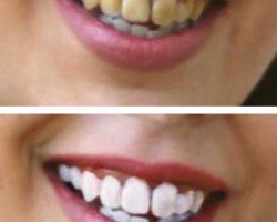 Consejos para cuidar tus dientes del sarro Consejos para cuidar tus dientes del sarro
