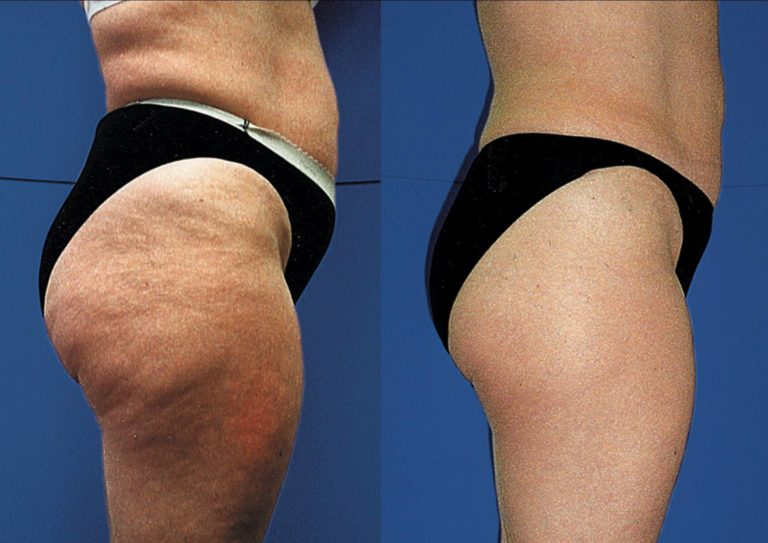 Consejos para prevenir la celulitis