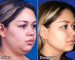 Consejos para reducir la papada