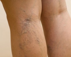 Consejos para aliviar las varices