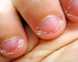Cómo dejar de morderse las uñas