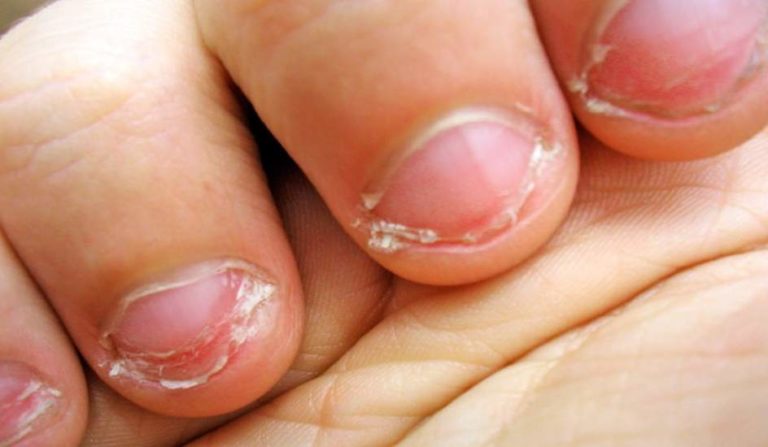 Cómo dejar de morderse las uñas