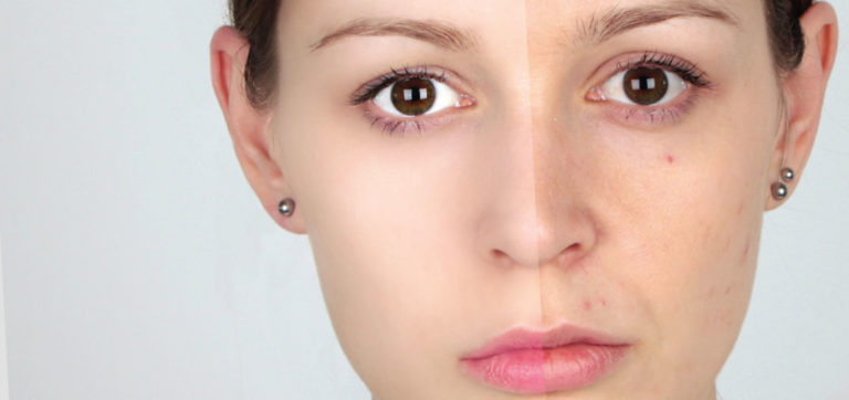 Aprender a eliminar las imperfecciones rápido
