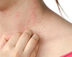 Cómo lidiar con las erupciones cutáneas Cómo lidiar con las erupciones cutáneas