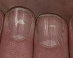 Cómo lidiar con los puntos blancos en las uñas Cómo lidiar con los puntos blancos en las uñas