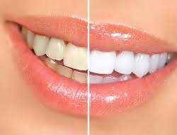 Cómo blanquear tus dientes