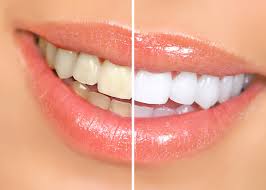 Cómo blanquear tus dientes