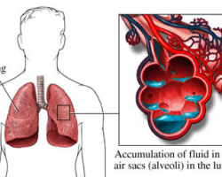 Aprender a tratar un edema pulmonar Aprender a tratar un edema pulmonar