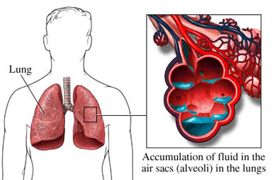 Aprender a tratar un edema pulmonar