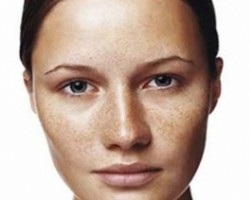 Aprender a tratar manchas oscuras de la piel Aprender a tratar manchas oscuras de la piel